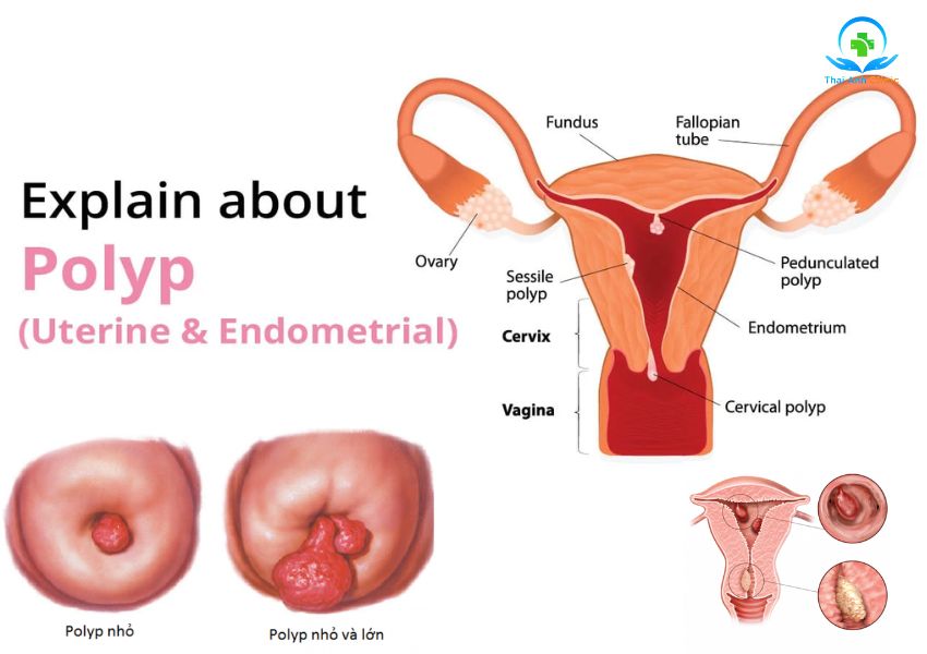 Polyp cổ tử cung là tình trạng tăng sinh bất thường của các tế bào nằm ở trên cổ tử cung.