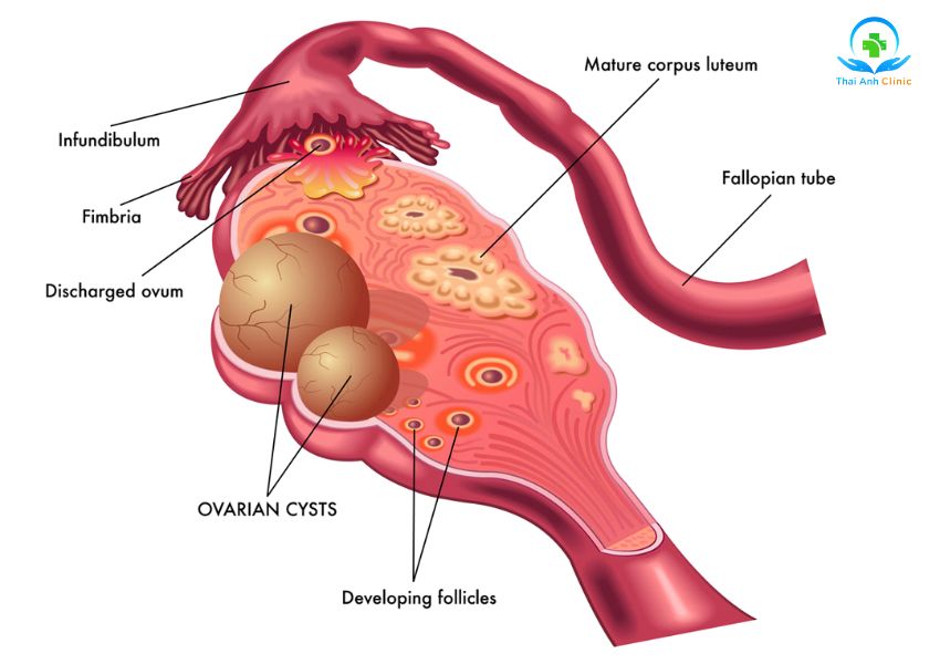 U nang buồng trứng là một dạng u lành hình thành và phát triển trong buồng trứng của phụ nữ.
